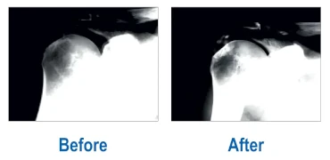 Dissolution of Calcified Fibroblasts